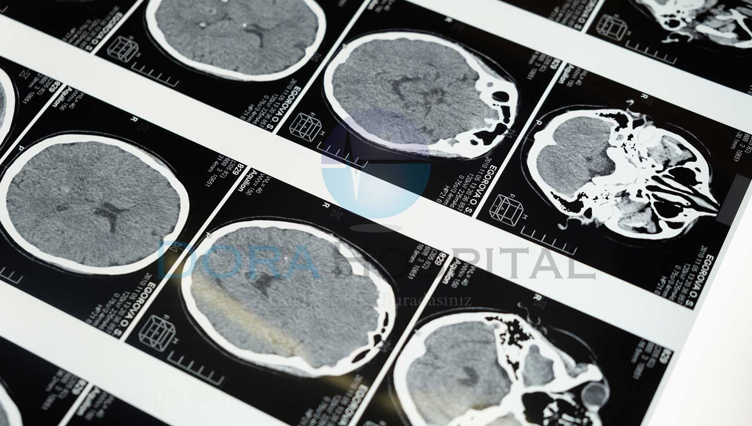 menenjit asisi fiyati 2021 dora hospital